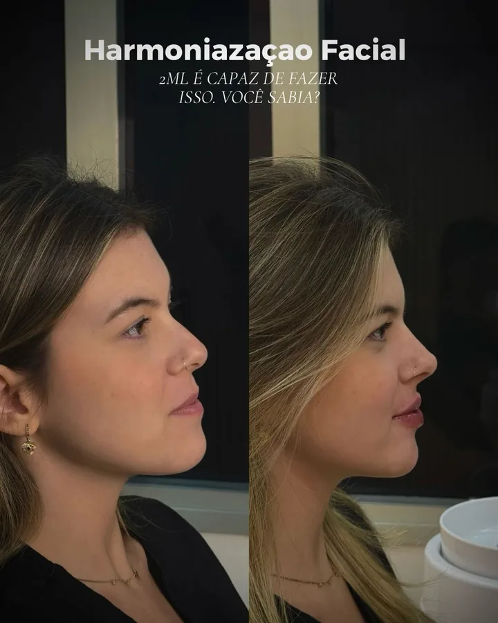Resultado de harmonização facial e botox de Thaís Mello